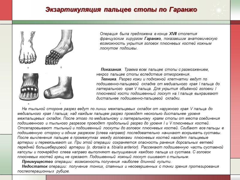 Экзартикуляция пальцев стопы по Гаранжо Операция была предложена в конце XVII столетия французским хирургом
